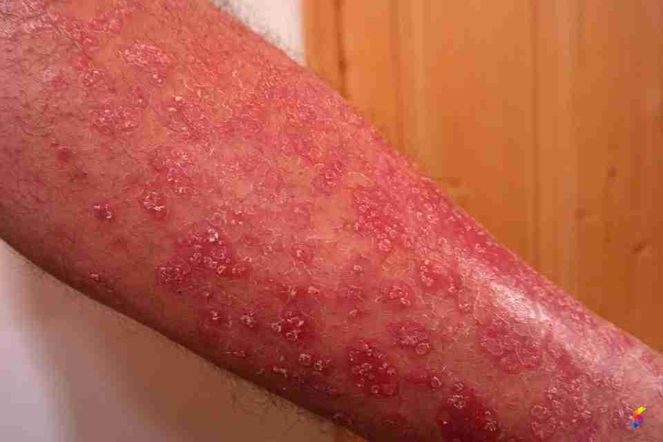 What is Meant by Rash: Causes, Symptoms, and Treatment Explained